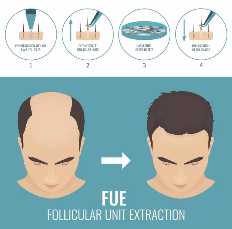 Fue-マイクロモーター充電機、ヘアインプランター、眉毛植栽 - Hair Care Basic のレビューと価格