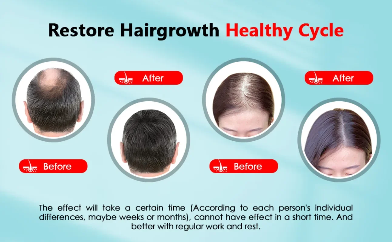 育毛キャップ充電式 2000mAh LED 健康光デバイス抗 - Hair Care Basic のレビューと価格